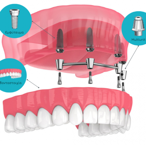 odontostoixia-me-emfyteymata